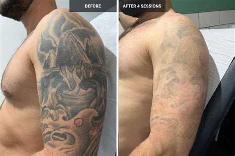 removery tattoo removal & fading|laser tattoo removal before and after photos.